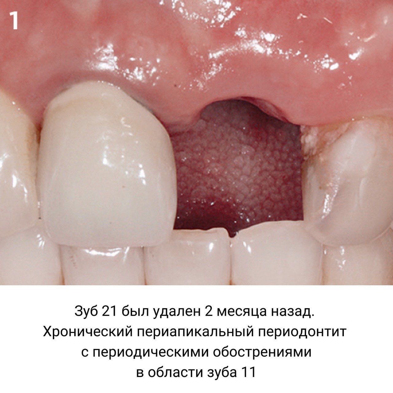 Лечение фенестрации и периапикального костного дефекта: кейс по клиническому случаю из практики Марелен Тео (Сингапур)